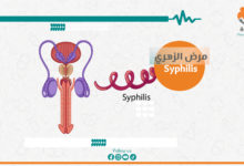 مرض الزهري