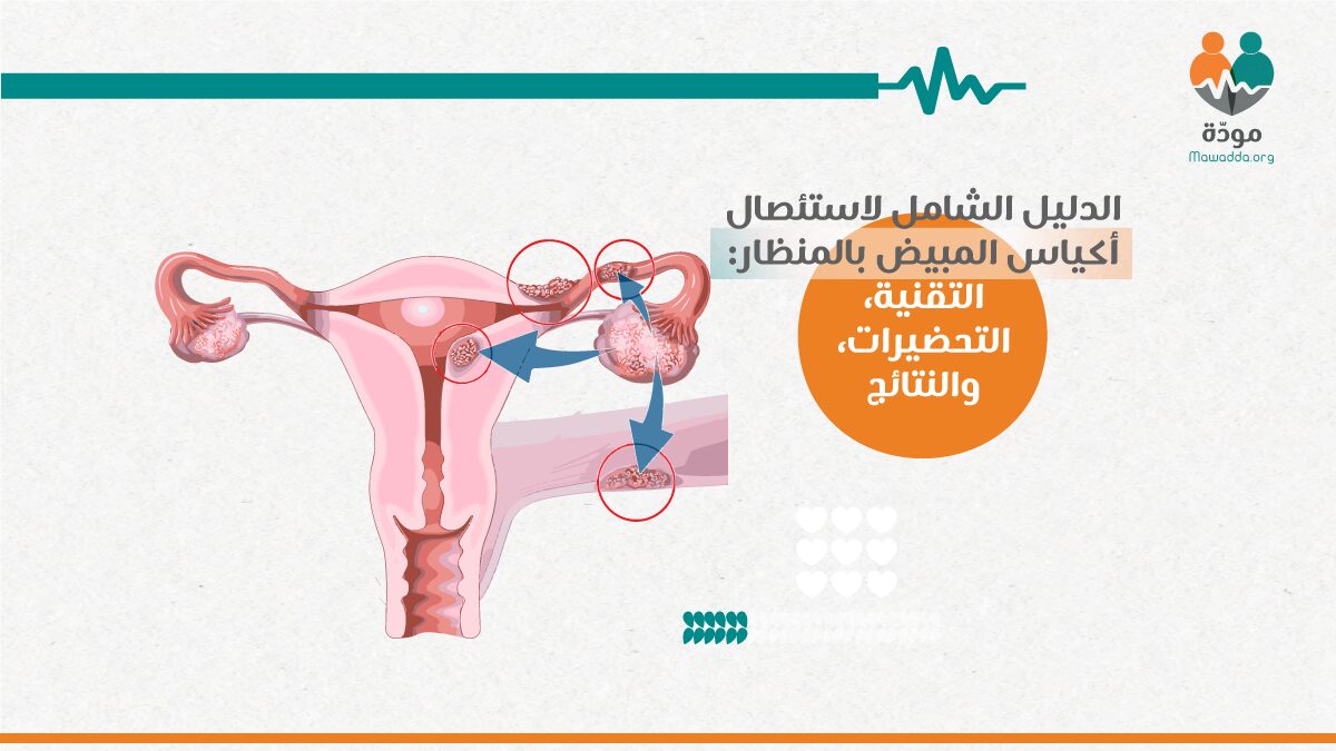 استئصال أكياس المبيض بالمنظار